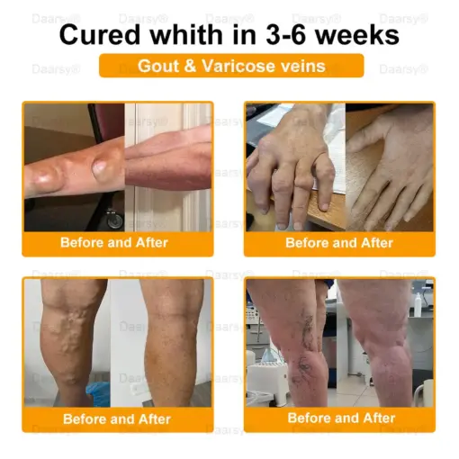 DAASRY® Bee Venom Pain-Relief Bone Healing Cream