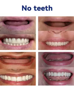 GripNFit™ Silicone Denture Set