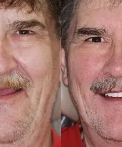 HZA™ --🦷Advanced Customized Full Denture Set🦷