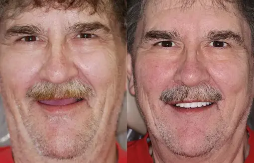 HZA™ --🦷Advanced Customized Full Denture Set🦷
