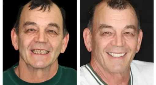 HZA™ --🦷Advanced Customized Full Denture Set🦷