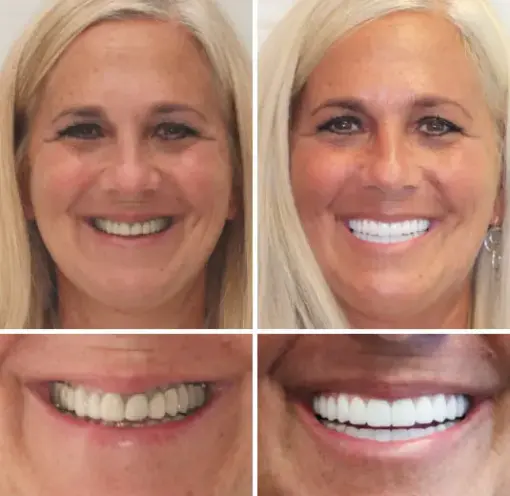 HZA™ --🦷Advanced Customized Full Denture Set🦷