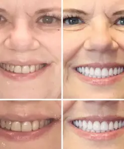 HZA™ --🦷Advanced Customized Full Denture Set🦷