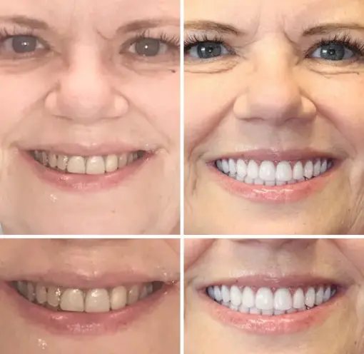 HZA™ --🦷Advanced Customized Full Denture Set🦷