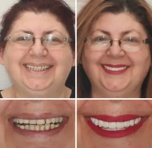 HZA™ --🦷Advanced Customized Full Denture Set🦷