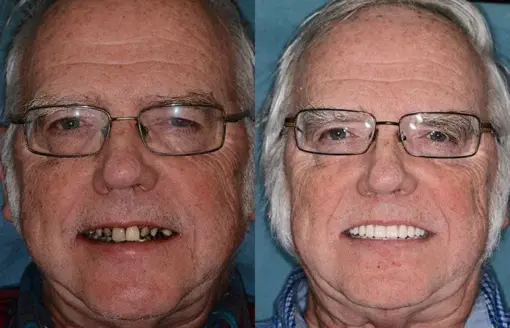 HZA™ --🦷Advanced Customized Full Denture Set🦷