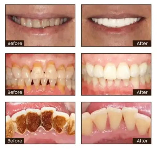 JEREMYTIS™ Ultra Whitening Mint Toothpaste