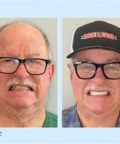 Smileasego™ - Premium Denture