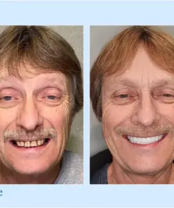 Smileasego™ - Premium Denture