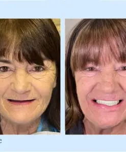 Smileasego™ - Premium Denture