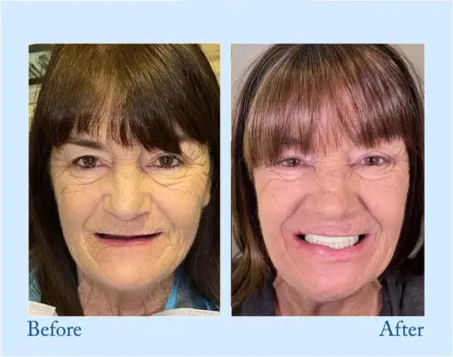 Smileasego™ - Premium Denture