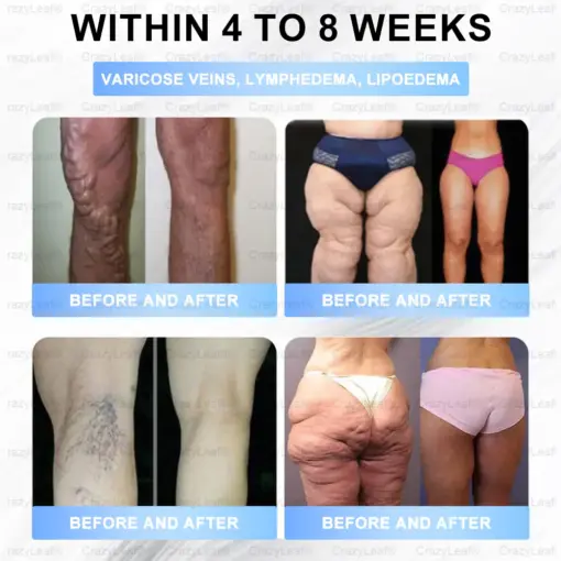 Buildleaf® Tirzepatide Slimming & Health Nano Microneedle Patch