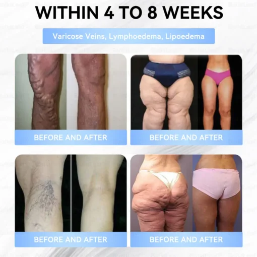 𝐁𝐮𝐢𝐥𝗱𝐋𝐞𝐚𝐟®𝐒𝐥𝐢𝐦 & 𝐅𝐢𝐫𝐦 𝐍𝐚𝐧𝐨 𝐌𝐢𝐜𝐫𝐨𝐧𝐞𝐞𝐝𝐥𝐞 𝐏𝐚𝐭𝐜𝐡